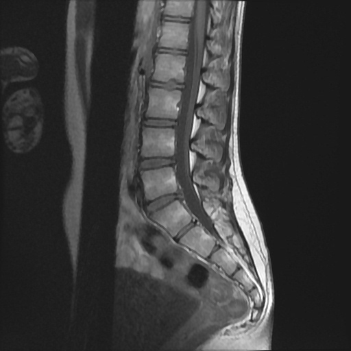 Lumbosacral Transitional Vertebrae Image Radiopaedia Org