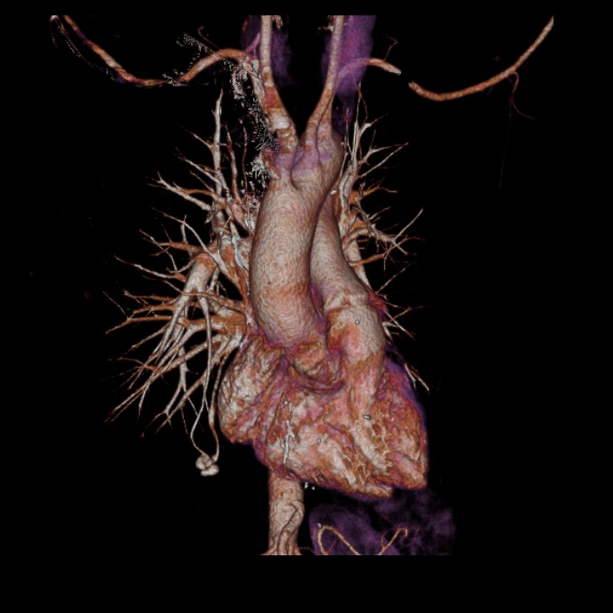 Pulmonary Arteriovenous Malformation Image Radiopaedia Org