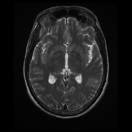 Choroid Plexus Xanthogranuloma Image Radiopaedia Org