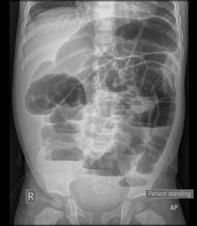 Small Bowel Obstruction Radiology Case Radiopaedia Org