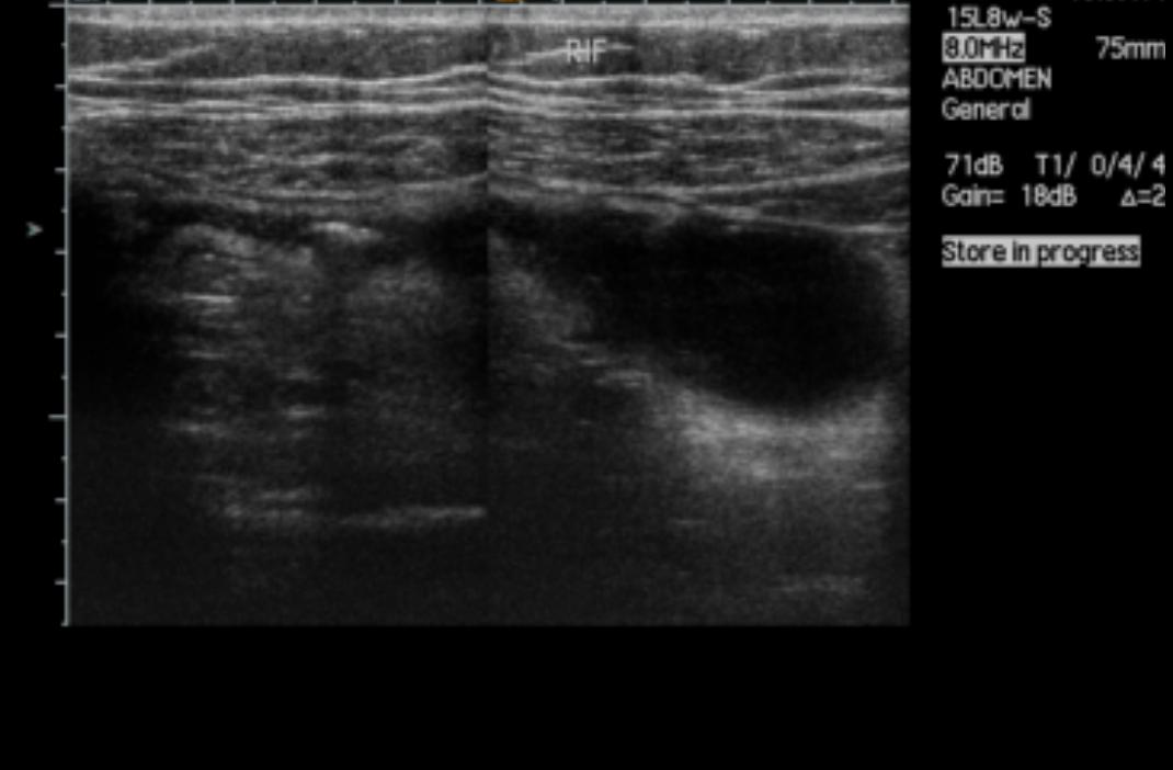 Meckel Diverticulitis Image Radiopaedia Org