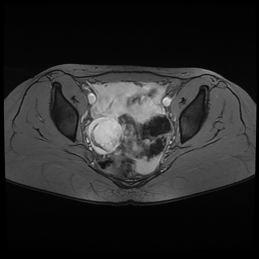 Ruptured Ovarian Hemorrhagic Cyst Image Radiopaedia Org