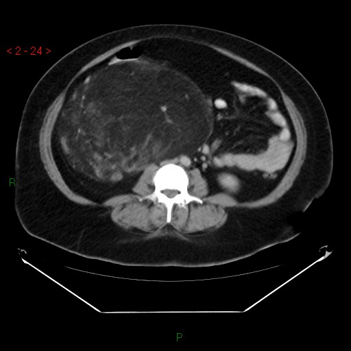 Renal Angiomyolipoma Image Radiopaedia Org