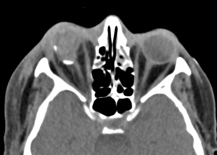 Globe Rupture Image Radiopaedia Org