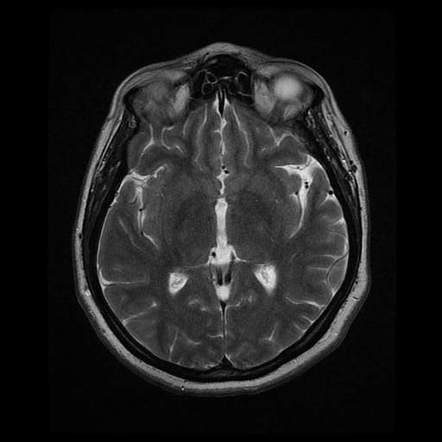 Cerebellopontine Angle Epidermoid Cyst Image Radiopaedia Org