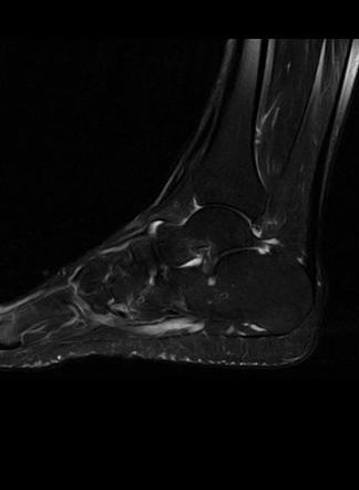 Accessory Navicular Syndrome Image Radiopaedia Org