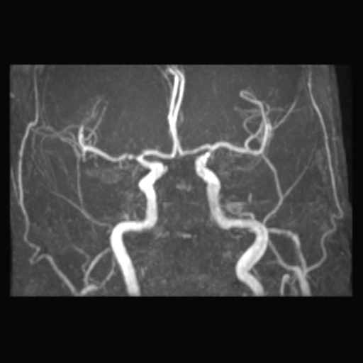 Subacute Hemorrhagic Cerebral Infarction Image Radiopaedia Org