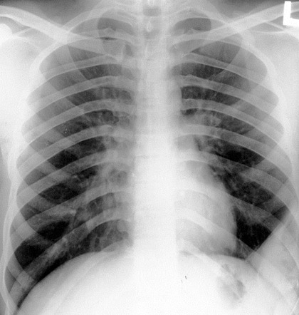 Diaphragmatic Hernia Simulating Pleural Effusion Radiology Case Radiopaedia Org