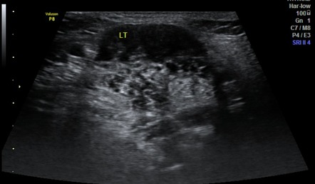 Chronic Submandibular Sialadenitis Image Radiopaedia Org