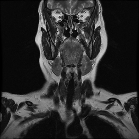 Chronic Submandibular Sialadenitis Image Radiopaedia Org