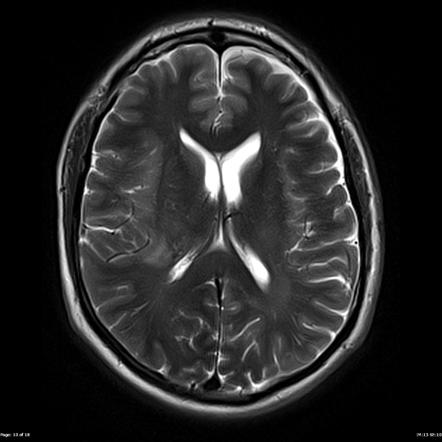 Gliomatosis Cerebri Image Radiopaedia Org