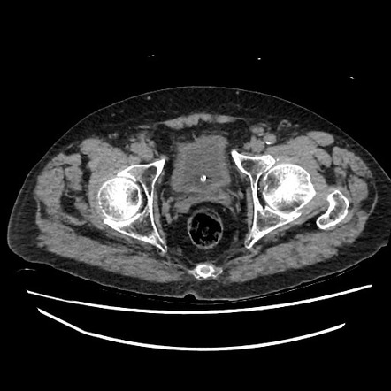 Sacral And Parasymphyseal Insufficiency Fractures Radiology Case