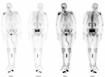 Sacral And Parasymphyseal Insufficiency Fractures Image Radiopaedia Org