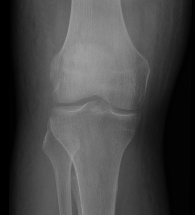 Prepatellar Gout On Dual Energy Ct Radiology Case Radiopaedia Org