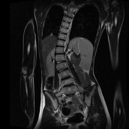 Osteoblastoma Vertebral Image Radiopaedia Org