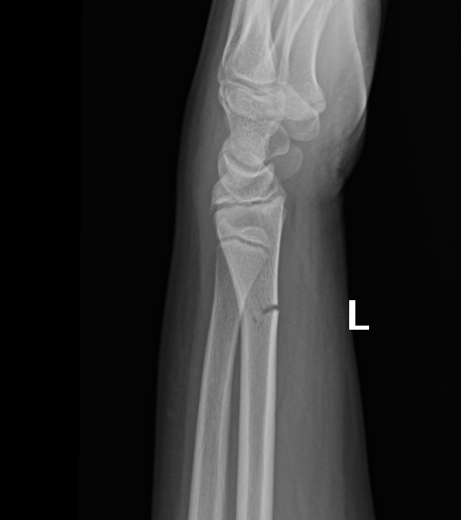 Transverse Distal Radial Fracture Image Radiopaedia Org