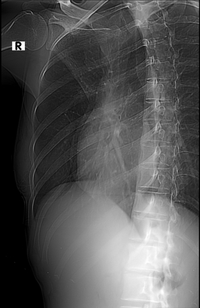 Rib Fracture Image Radiopaedia Org