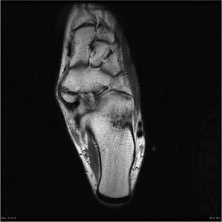 Accessory Navicular Radiology Reference Article Radiopaedia Org