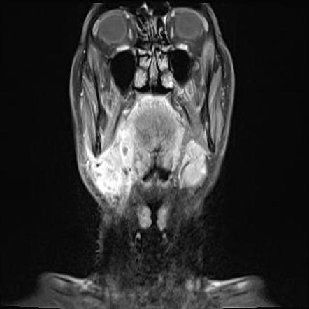 Acute Submandibular Sialadenitis Mri Image Radiopaedia Org