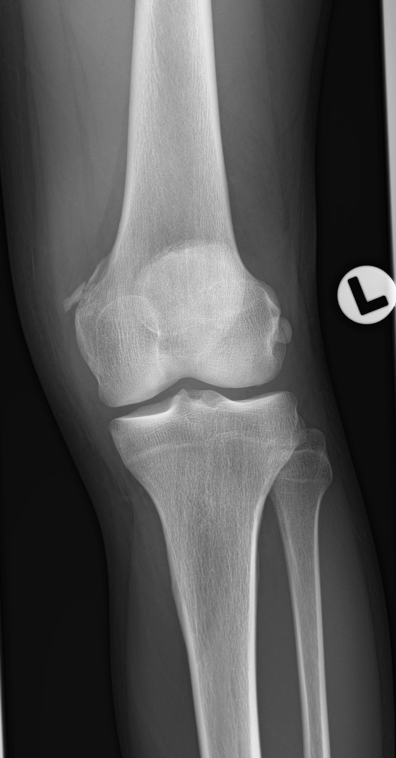 Patellar Avulsion Fracture Articular Loose Body Old Stieda Pellegrini