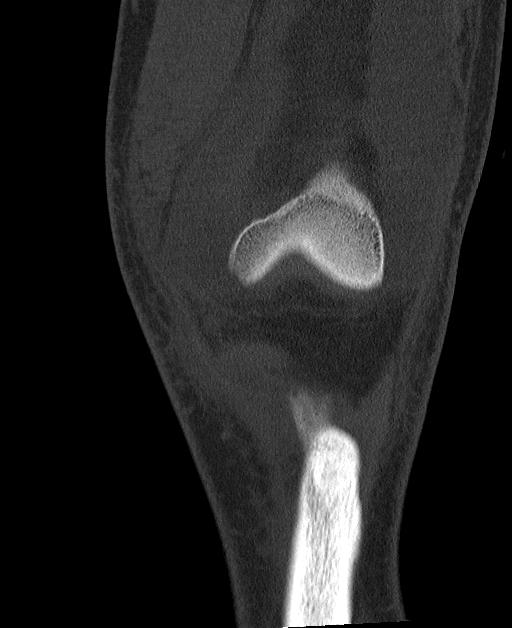 File Patellar Avulsion Fracture Articular Loose Body Old Stieda