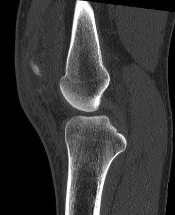 Patellar Avulsion Fracture Articular Loose Body Old Stieda Pellegrini