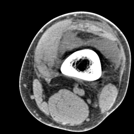 File Patellar Avulsion Fracture Articular Loose Body Old Stieda