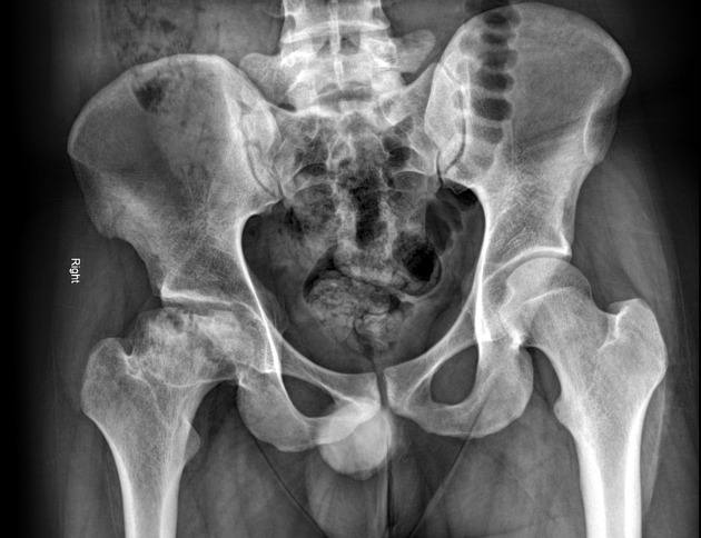 Osteonecrosis Of The Hip