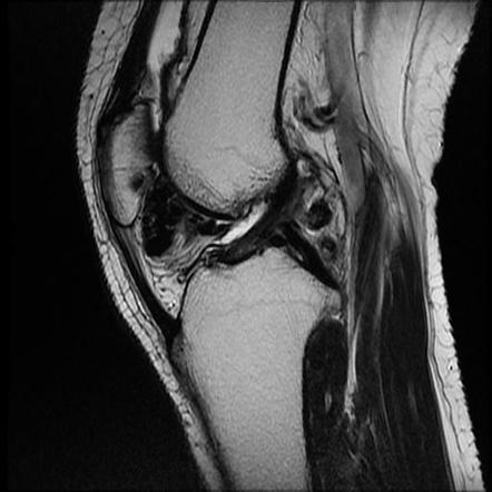 Pigmented Villonodular Synovitis