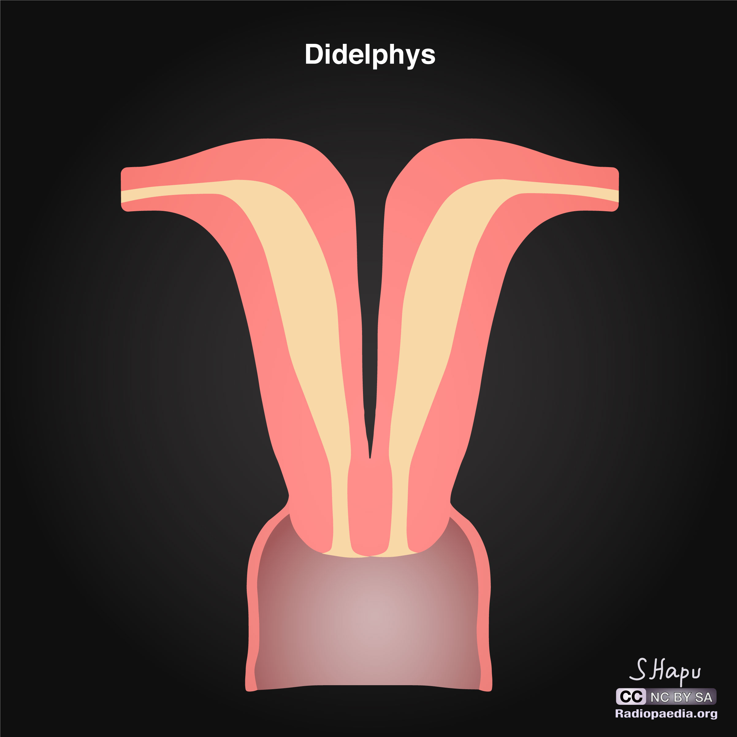 Uterine Anatomical Abnormalities Illustrations Image Radiopaedia Org