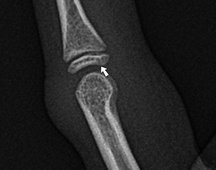 Volar Plate Avulsion Injury Radiology Reference Article Radiopaedia Org