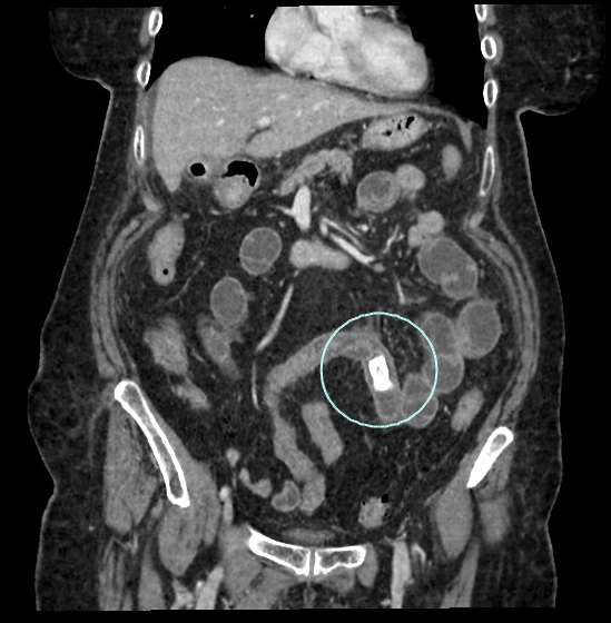 Gallstone Ileus Image Radiopaedia Org