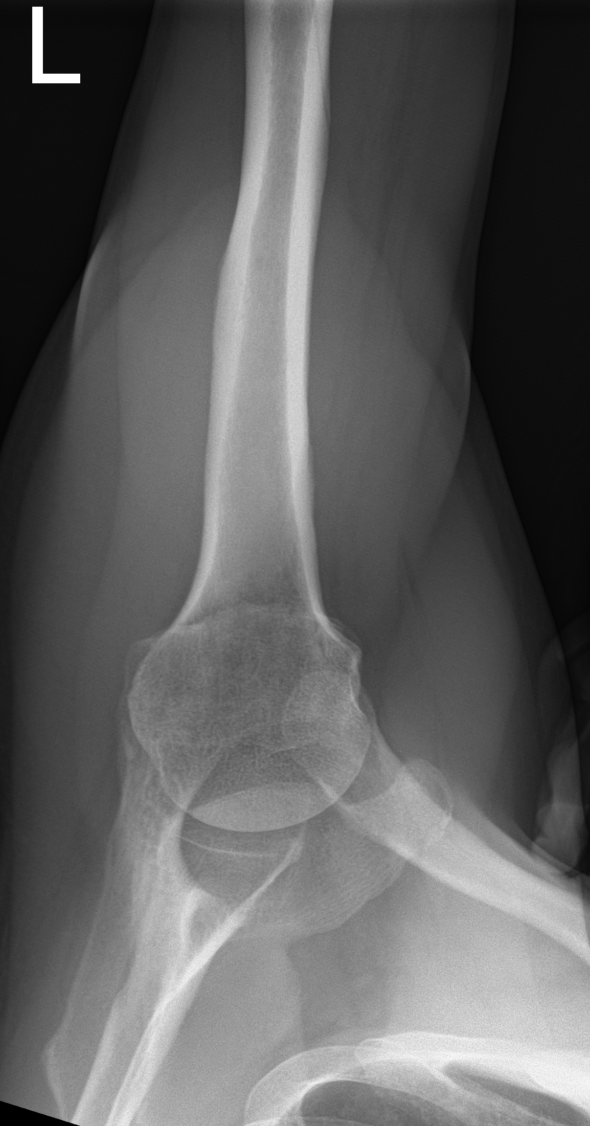 Calcific Supraspinatus Tendinitis Image Radiopaedia Org