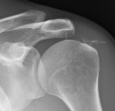 Calcific Tendinitis Of Supraspinatus Tendon Radiology Case Hot Sex Hot Sex Picture