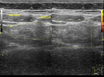 Omental Infarction Radiology Reference Article Radiopaedia Org