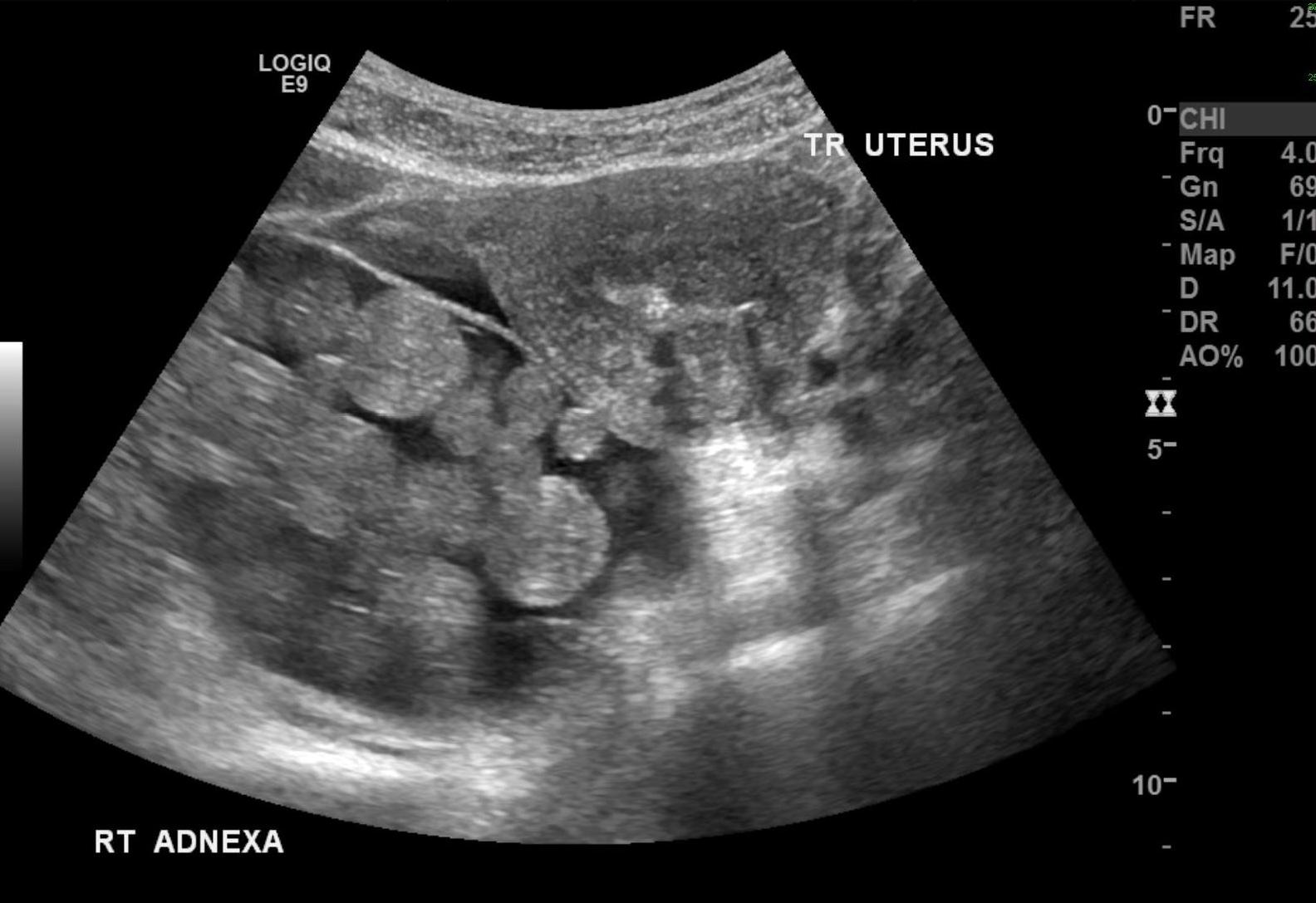 Radiopaedia Ovarian Cyst