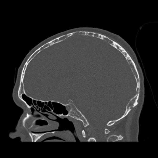 Multiple Myeloma Raindrop Skull Image Radiopaedia Org