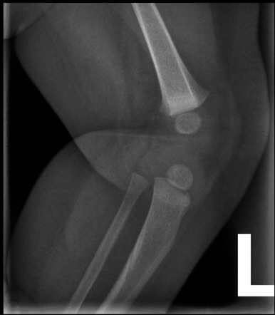 Nail Patella Syndrome Radiology Reference Article Radiopaedia Org