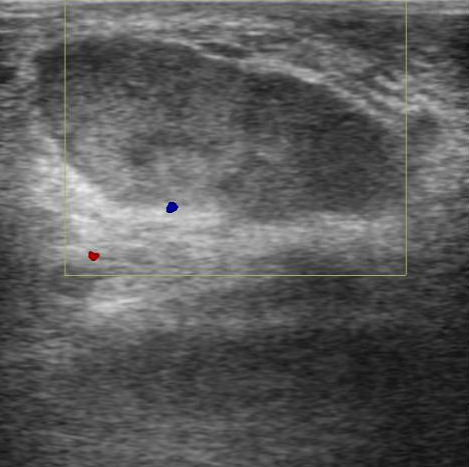 Subcutaneous Hematoma Distal Leg Image Radiopaedia Org