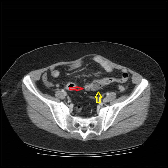 Meckel S Diverticulitis Image Radiopaedia Org