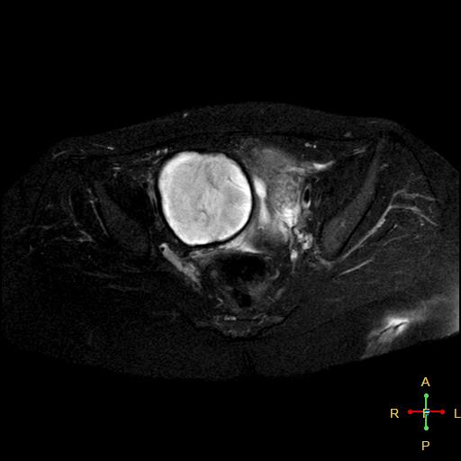 Hemorrhagic Ovarian Cyst Image Radiopaedia Org