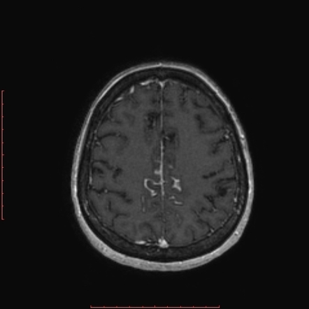 Gyral Enhancement Radiology Reference Article Radiopaedia Org