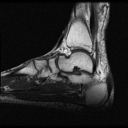 Achilles Tendon Tear Image Radiopaedia Org