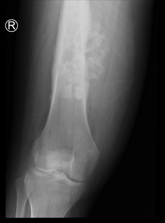 Telangiectatic Osteosarcoma Image Radiopaedia Org