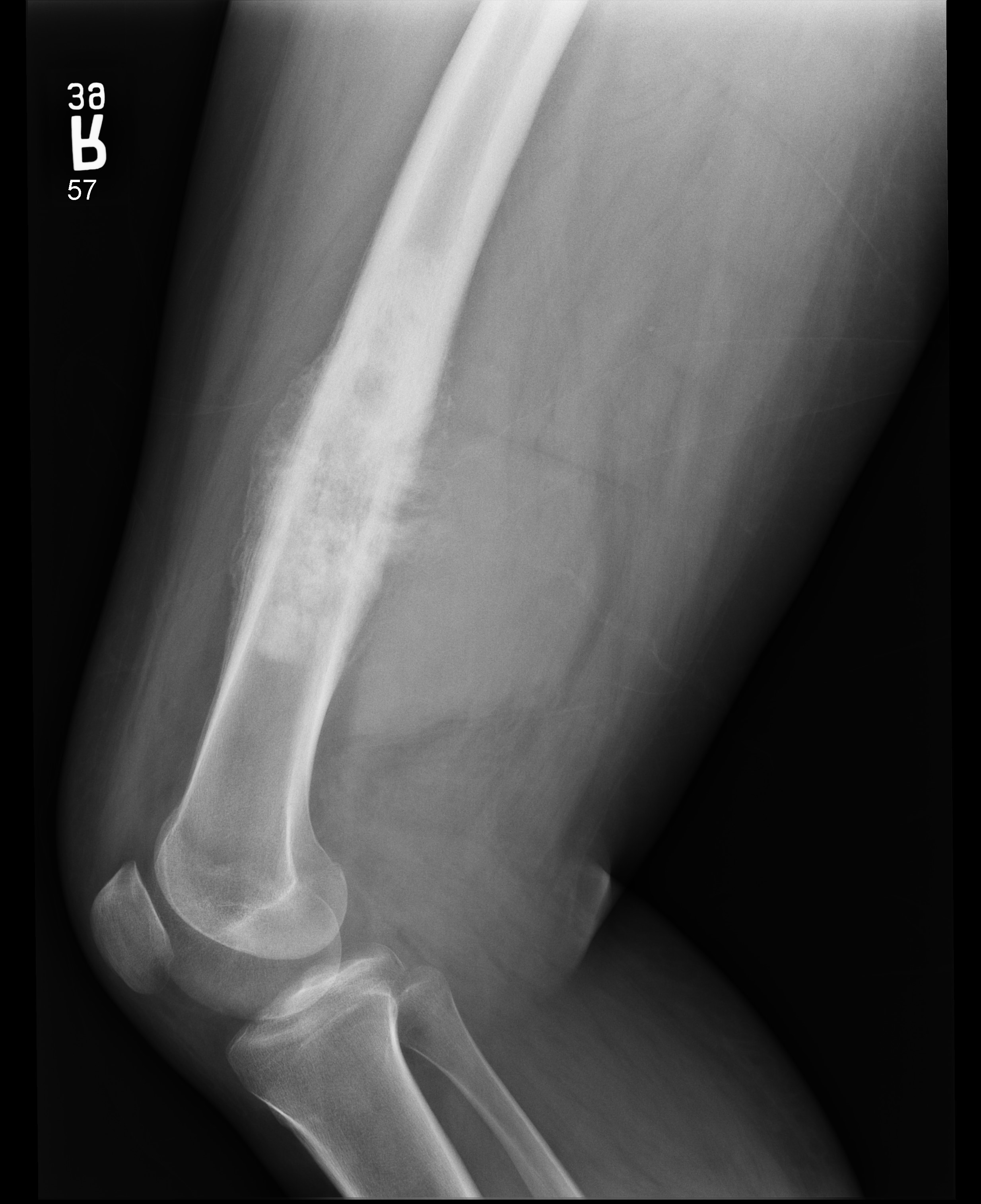 Telangiectatic Osteosarcoma Image Radiopaedia Org