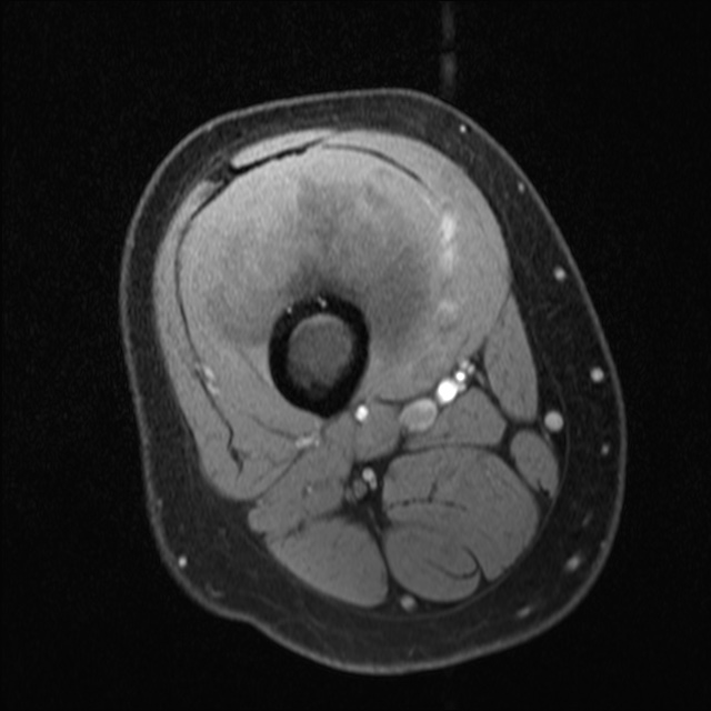 Periosteal Osteosarcoma Image Radiopaedia Org