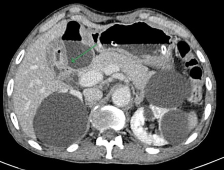 Gallstone Ileus Image Radiopaedia Org