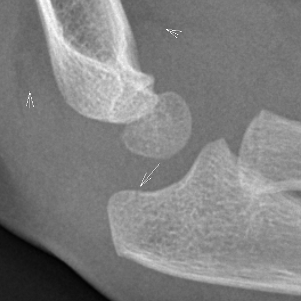 Pediatric Olecranon Fracture Subtle Image Radiopaedia Org