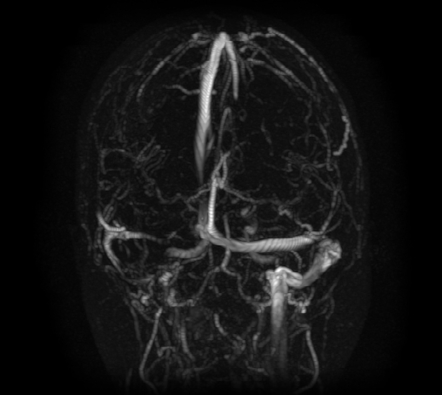 Idiopathic Intracranial Hypertension Image Radiopaedia Org