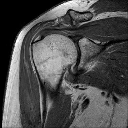 Subcoracoid Impingement With Subscapularis Tendinosis And Partial Tear